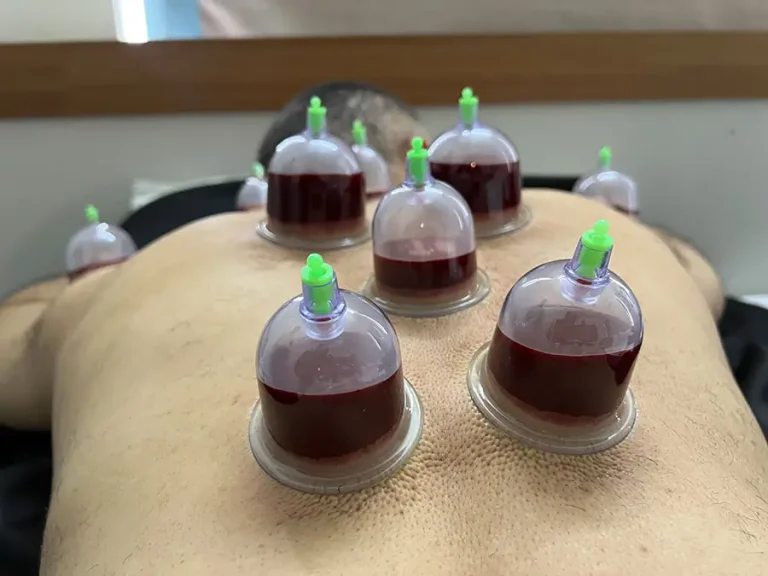 Ayurvedic Raktamokshana Bloodletting and Hijama Cupping Therapy at Shri Vishwavedhika Clinic Kharadi Pune