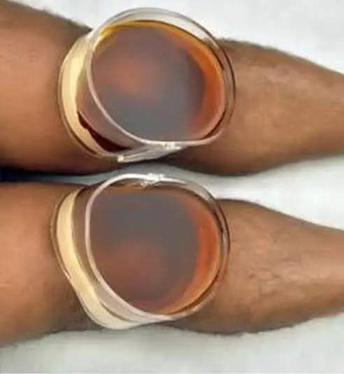 Janu Basti Ayurvedic Knee Joint Pain and Osteoarthritis Treatment in Kharadi Pune